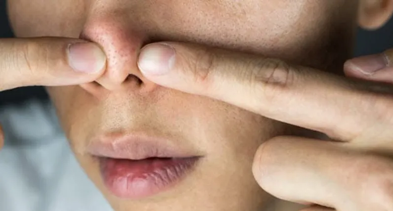Could Popping a Pimple Really Kill You? A Doctor Explains the ‘Triangle of Death’